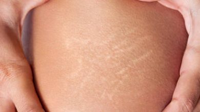 Easy ways to remove stretch marks