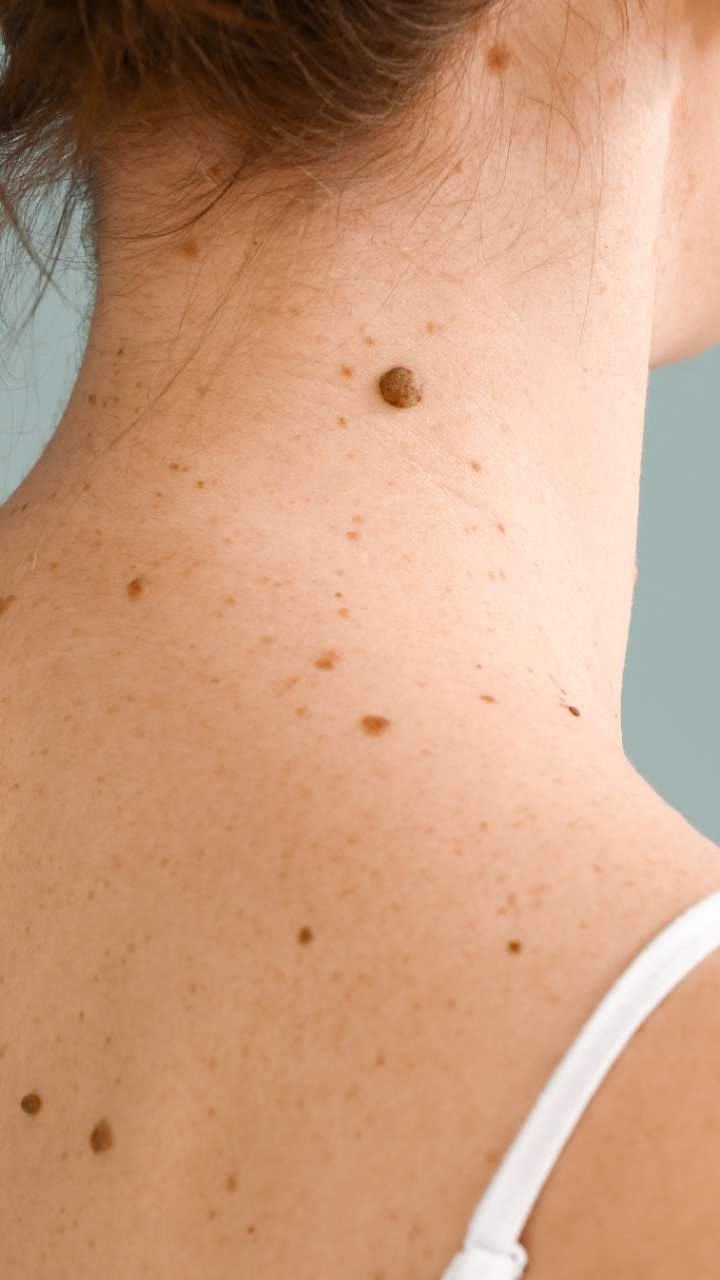 What parts of happy people have moles?