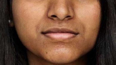Eat these things that contain vitamin B12 when the face is black