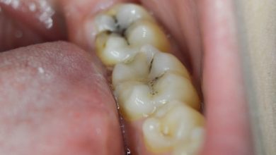 Tooth decay: causes, symptoms and treatment