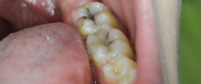 Tooth decay: causes, symptoms and treatment