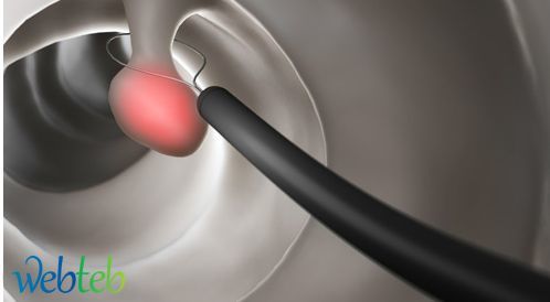 Watch the video: colonoscopy