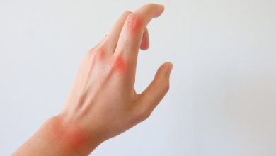 Causes of rheumatoid arthritis