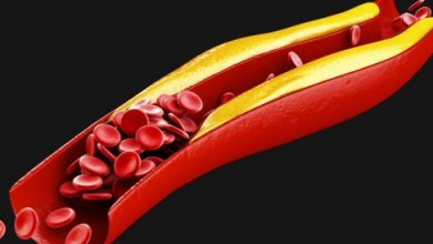 High Cholesterol: Causes, Symptoms and Treatment Methods