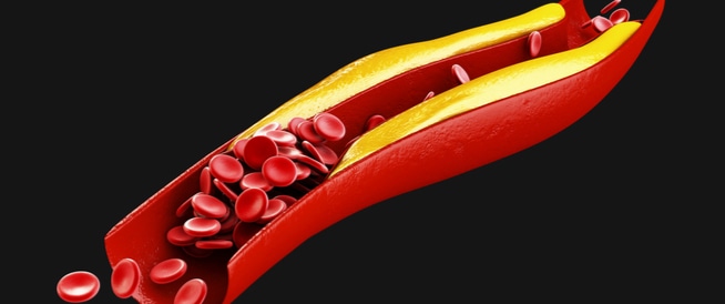 High Cholesterol: Causes, Symptoms and Treatment Methods