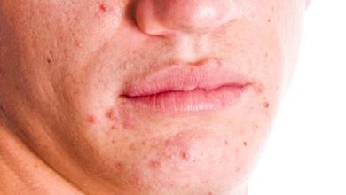 Acne: causes, symptoms and treatment