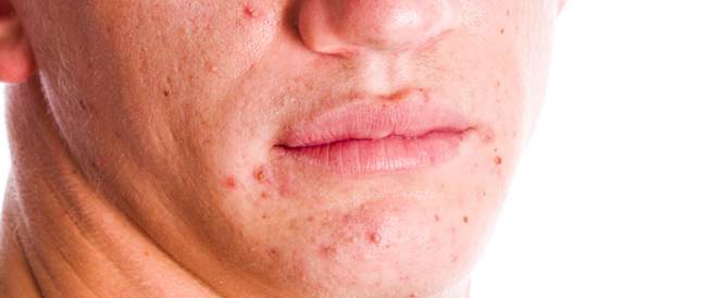 Acne: causes, symptoms and treatment