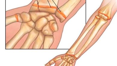 Children’s fractures .. causes, symptoms and treatment methods
