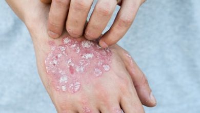 Psoriasis: Causes, Symptoms and Treatment