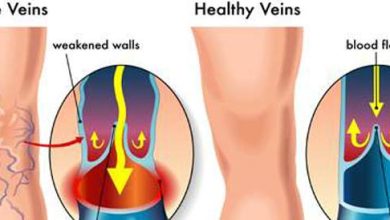 Varikosis: Causes, Symptoms and Treatment