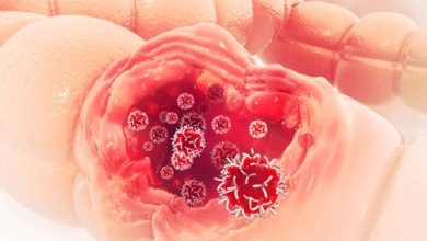 Colon Cancer: Causes, Symptoms and Treatment