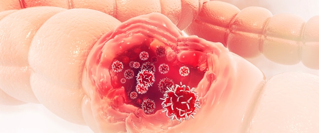 Colon Cancer: Causes, Symptoms and Treatment
