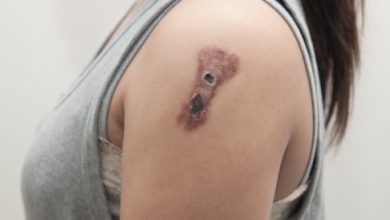 Skin Cancer: Causes, Symptoms and Treatment
