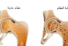 هشاشة العظام: الأعراض، والأسباب، والعلاج