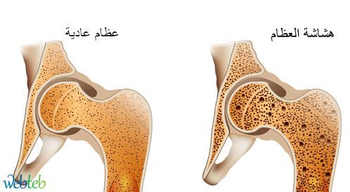 هشاشة العظام: الأعراض، والأسباب، والعلاج