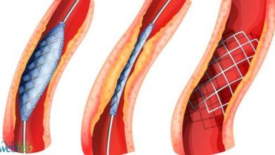 Watch the video: the catastrophic catheter