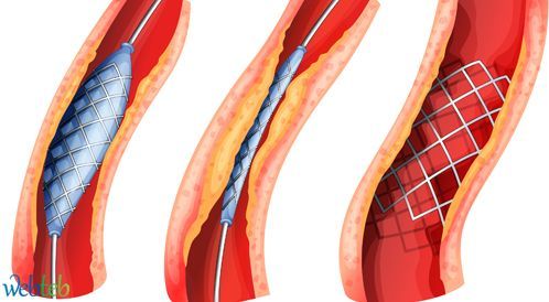 Watch the video: the catastrophic catheter