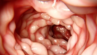 Crohn’s disease: causes, symptoms and treatment