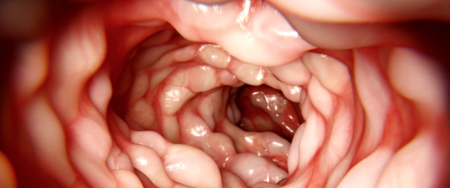 Crohn’s disease: causes, symptoms and treatment