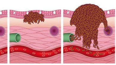 Video: The early stages of melanoma