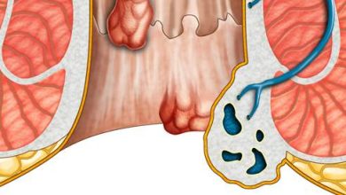 Hemorrhoids: Causes, Symptoms and Treatment