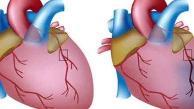 Cheaphopathic: Causes, Symptoms and Treatment