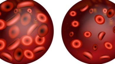 Anemia: causes, symptoms and relationship