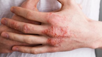 Eczema: Causes, symptoms and treatment