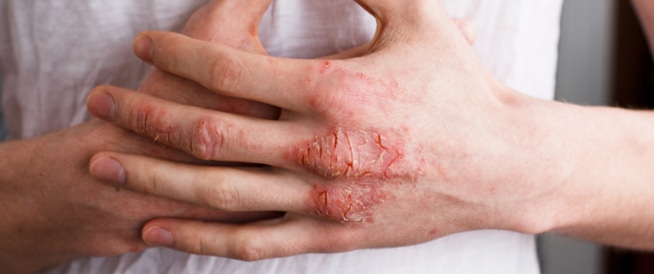 Eczema: Causes, symptoms and treatment