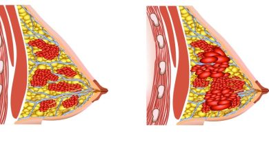 Breast enlargement: Details of your interest
