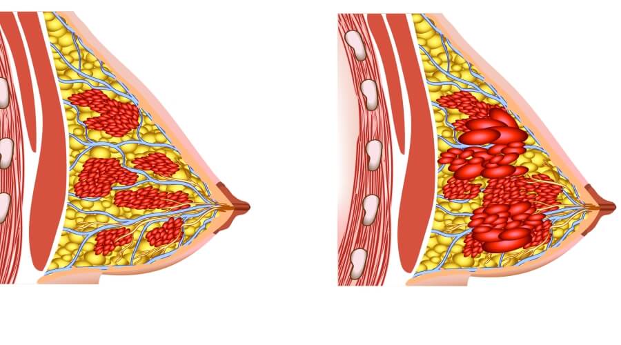 Breast enlargement: Details of your interest