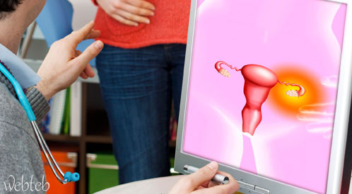 Video: Multi -Cysty Ovarian Syndrome