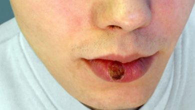 Syphilis: Causes, Symptoms and Treatment