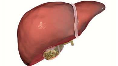 Gallstones: causes, symptoms and treatment