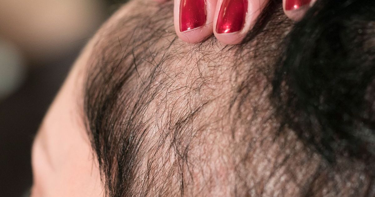 Intermittent fasting can delay hair growth