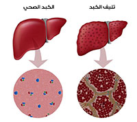 Deliver cirrhosis: symptoms, causes and treatment