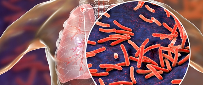Tuberculosis: Causes, Symptoms and Treatment