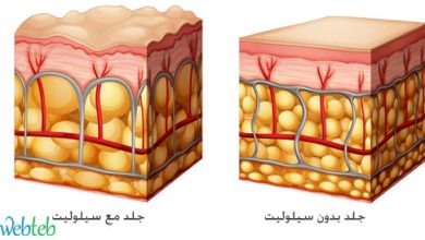 See: Causes of symptoms and treatment of cellulite