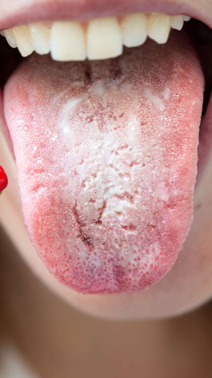 White tongue is caused by what disease?