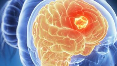 Braink Cancer: Causes, Symptoms and Treatment