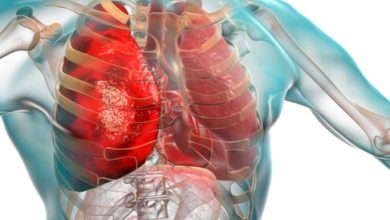 Pneumonia: Causes, Symptoms and Treatment