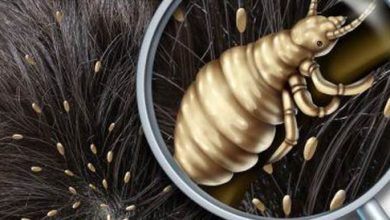 Lice: symptoms and treatment of lice