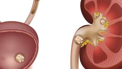 Kidney stones: Asaba, symptoms and treatment