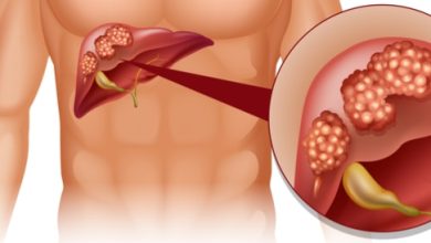Liver cancer: causes, symptoms and treatment