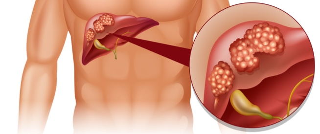 Liver cancer: causes, symptoms and treatment
