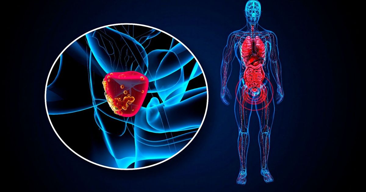 Researchers create a new way to treat aggressive prostate cancer