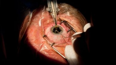 Corneal transplantation