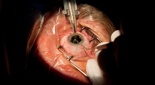 Corneal transplantation