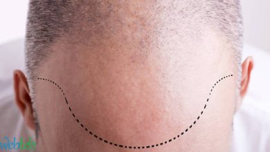 Video: Increase hair growth in surgical methods