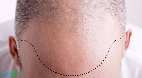 Video: Increase hair growth in surgical methods
